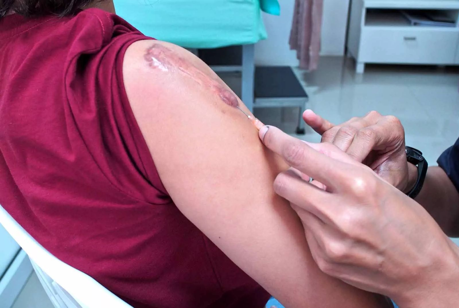 Injections for Keloid